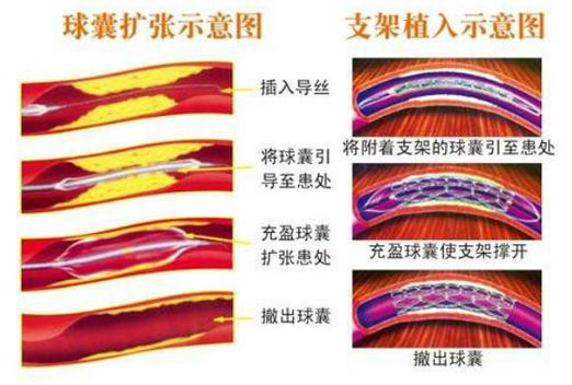 心脏球囊扩张术图解图片